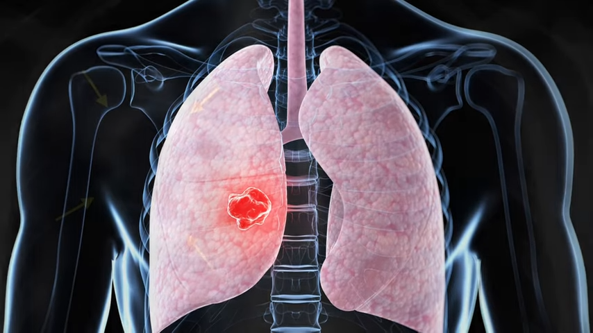 graphic representation of two lungs inside the chest cavity and a tumor is illuminated in one of the lungs
