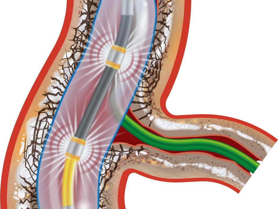 Shockwave Catheter in Artery