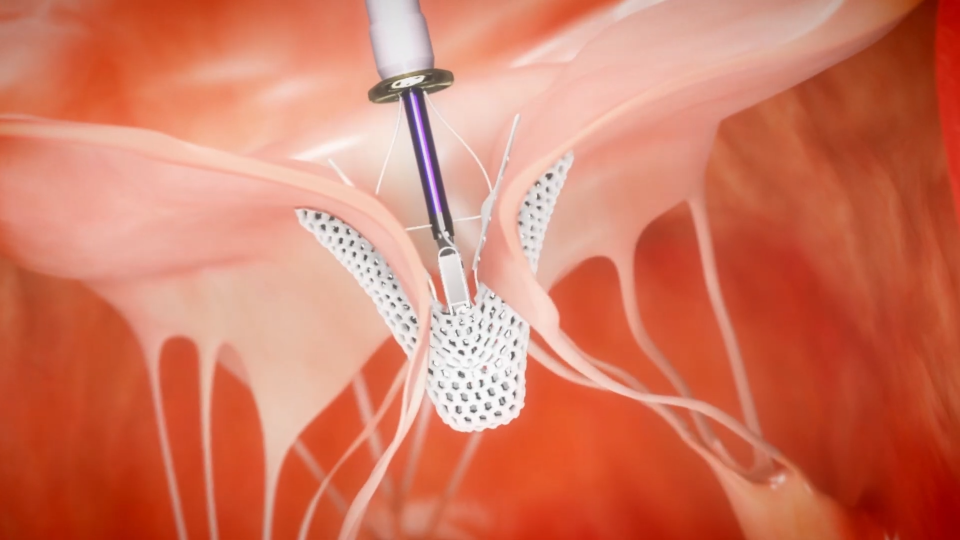 triclip in action closing leaflets of Tricuspid valve