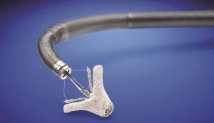 MitraClip