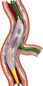 Shockwave Catheter in Artery