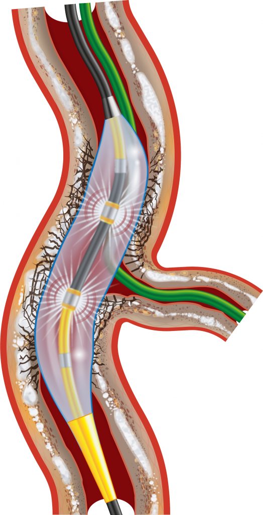 Shockwave Catheter in Artery