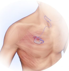 graphic of an inspire sleep apnea device implanted in chest
